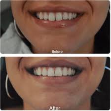 Your dental expert can thoroughly sculpt this resin into the proper sizes and shape to cover the gap in between your front incisors. Composite Bonding Caerleon Newport Isca Dental