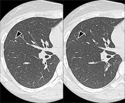 Thoracic endometriosis syndrome (tes) is a rare disorder characterized by the presence of functioning endometrial tissue in the pleura, the lung parenchyma and … Resection Of Pulmonary Endometriosis Using Video Assisted Thoracoscopic Surgery Under Preoperative Ct Guided Marking Springerlink