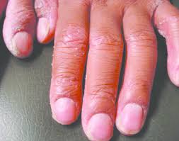 Há alguns anos sofri de psoriase , doença, que na altura em que podia ser bem visível em mim. Onicodistrofia Associada A Psoriase Download Scientific Diagram