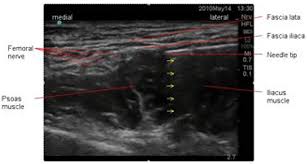 Lateral femoral cutaneous nerve ultrasound. Fascia Iliaca Compartment Block Landmark And Ultrasound Approach Wfsa Resources
