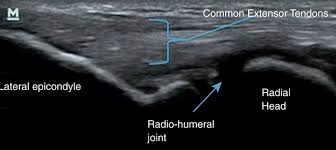 Image result for Epicondyle Injection