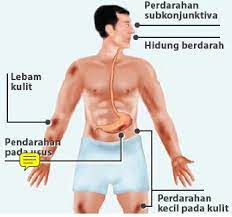 Kementerian kesihatan menjangkakan akan berlaku peningkatan kes demam denggi gelombang kedua bermula awal jun. Kenali Denggi