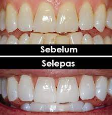 Servis perkhidmatan yang cepat dan juga sangat murah untuk rawatan gigi yang sihat bersih. Ini 2 Rawatan Pemutihan Gigi Yang Anda Boleh Lakukan Iluminasi