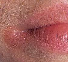 заеды в уголках рта причины и лечение у взрослых 10 Prichin Poyavleniya Treshin V Ugolkah Rta