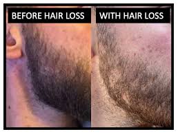 Selenium also has antioxidant properties, the nhs recommend men get can too much zinc cause hair loss. What Is Causing My Beard Body And Scalp Hair Loss Donovan Hair Clinic
