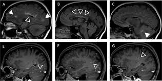 Doctors call these conditions demyelinating diseases. Successful Disease Control With Alemtuzumab In Mog Igg Associated Demyelinating Disease With Ms Phenotype Multiple Sclerosis And Related Disorders