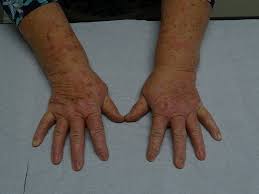 Image result for Photodermatitis