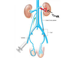 Renal Neoplasia For Sudden Onset Left Sided Varicocele Think Renal Cell Carcinoma Renal Renal Cell Carcinoma Medical Coding