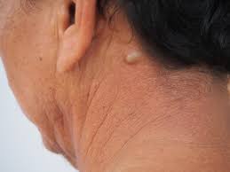 Granulom Ursachen Beschwerden Therapie Gesundpedia De