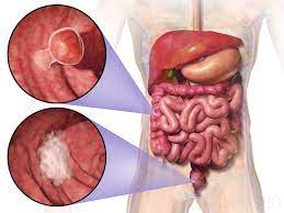Polyps are growths inside the colon. Colorectal Cancer Wikipedia