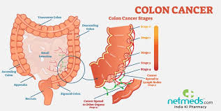 Diarrhea, constipation, or feeling that the bowel does not empty all the way. Colon Cancer Causes Symptoms And Treatment
