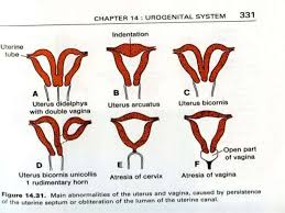 Mullerian agenesis refers to a condition in a female where the mullerian ducts fail to develop and a uterus will not be present. Mullerian Anomalies