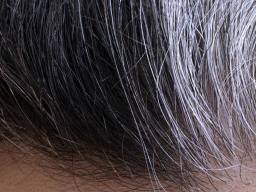 Locket, used to store a single lock of a loved one's hair.) Poliosis Causes Symptoms And Treatment