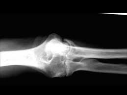 Rheumatoid arthritis is an inflammatory arthritis affecting both small and large joints in a symmetric distribution. Rheumatoid Arthritis Of Elbow On X Ray Youtube