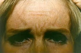 Botox treatment Before & After Photos Patient 141