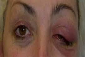 Image result for Dacryoadenitis