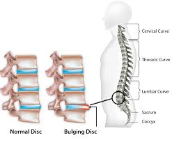 On the off chance that this happens, crisis surgical procedure is the main choice. Herniated Disc Slipped Disc Causes And Symptoms Sportnova Uk