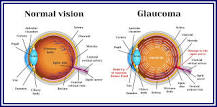 Image result for what is the treatment for narrow angle glaucoma?