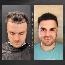 Haartransplantation vor und nach den Ergebnissen