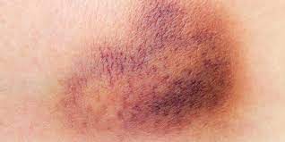 Hamatom Symptome Sind Schmerzen Und Verfarbungen Der Haut