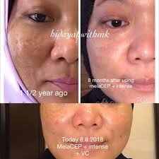 Mengekalkan pori sentiasa dalam keadaan bersih sesuai untuk masalah jerawat kritikal. Review Testimoni Set Lumivie Mary Kay