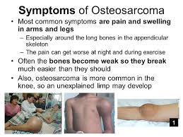Some early cancers may have signs and symptoms that can be noticed, but that's not always the case. Bone Cancer Groups Group 1 Primary Cancer And Primary Bone Cancer Group 2 Osteosarcoma Facts And Causes Group 3 Osteosarcoma Symptoms Treatment Ppt Download