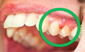 علاج التهاب اللثة في المنزل ادوية التهاب اللثة مجلة رجيم