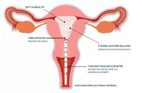 Image result for Female Infertility