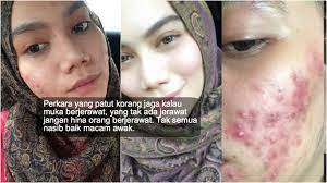 Bergantung kepada jenis kulit, anda mungkin boleh menggunakan skrub muka setiap selang sehari atau hanya sekali seminggu. Dulu Muka Berjerawat Rosak Teruk Gadis Ini Kongsi Perkara Penting Korang Perlu Jaga Elak Jerawat