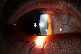 Image result for Ciliary Flush