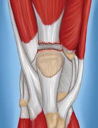 When the tendon is healed, it will still have a thickened, bowed appearance that feels firm and woody. Quadriceps Tendon Tear Orthoinfo Aaos