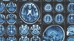 Signs of cancer in the brain include headaches, seizures, vision changes, and dizziness. Looking For Brain Metastases Cancer Today