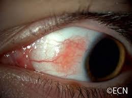 Image result for conjunctival melanoma
