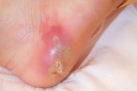 Image result for Skin Abscess