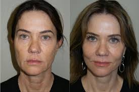 Top Lifestyle Lift Doctors in Newport Beach, CA