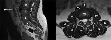 Check spelling or type a new query. Longitudinal Analysis Of Paraspinal Muscle Cross Sectional Area During Early Adulthood A 10 Year Follow Up Mri Study Scientific Reports