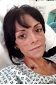 Crohn's disease: Mum's C-section scar explodes, needs 7 organ transplants