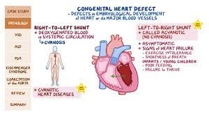 Acyanotic Congenital Heart Defects Pathology Review Osmosis