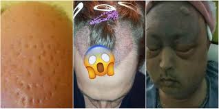 Bir Daha Düşünün! Saç Ektirme Operasyonu Yaptıranların Başına Gelen Kabus  Gibi Olaylar