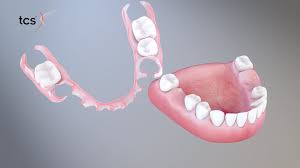 metal free partials and dentures