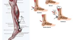Surgery can lead to pain and infection. Achilles Tendon Stretching Don T Do It Youtube