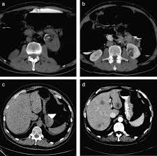 Image result for CT Intravenous Contrast