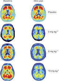 The prime study of the immunotherapy agent aducanumab for alzheimer's disease made big news recently. The Antibody Aducanumab Reduces Ab Plaques In Alzheimer S Disease Nature