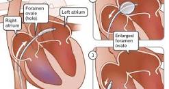 Image result for rashkind balloon atrial septostomy
