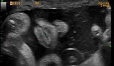 We did not find results for: Semana 33 De Embarazo Inatal El Embarazo Semana A Semana