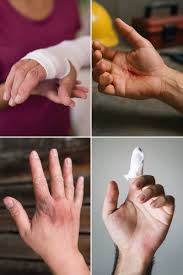 Image result for Hand Injury