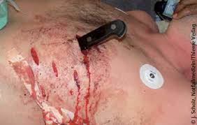 Er erlitt beim aussteigen einen bauchschlagaderdurchbruch, brach sofort darauf zusammen und starb an innere verblutung innerhalb von wenigen minuten. Tief Ins Fleisch Notfall Verletzungen Durch Waffen Klinik Via Medici
