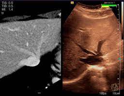 Ada yang tahu apa itu fdn (fixed dialing number? Ultrasound Fusion Imaging Sciencedirect