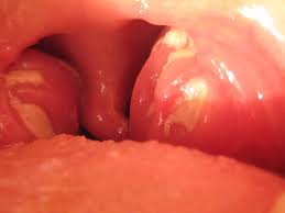 Your doctor can usually diagnose mono based on your symptoms. As Someone Who Had Infectious Mononucleosis What Are The Treatment Options To Reduce The Swelling Of Lymph Nodes And Tonsils