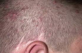 With alopecia areata, the body's cells attack the hair follicle, causing an itchy scalp and hair loss. Why Itchy Scalps And Hair Loss Love Each Other